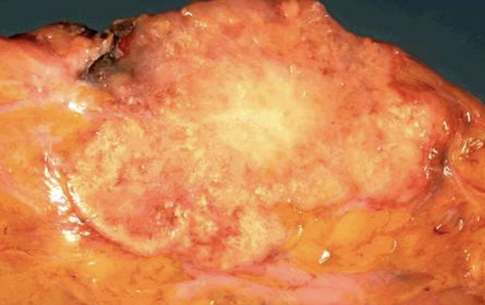 <p>Dystrophic calcium deposits around tumor detectable by mammography.</p>