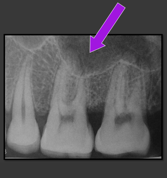 <p>It is a radiolucent space that sits above the maxillary teeth.</p>