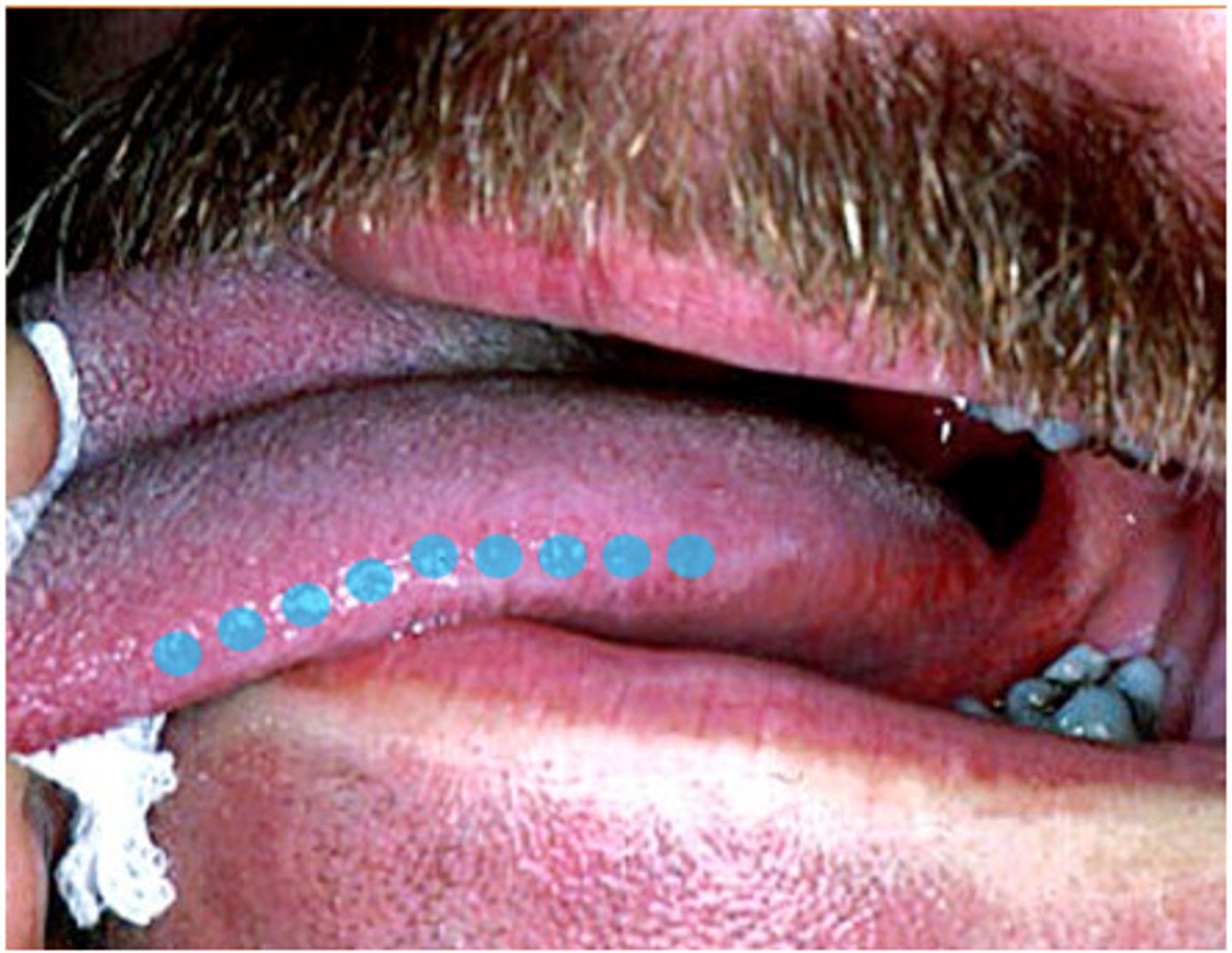 <p>Tongue papillae that are located on the lateral surface of the tongue, some contain taste buds that are red in color.</p>