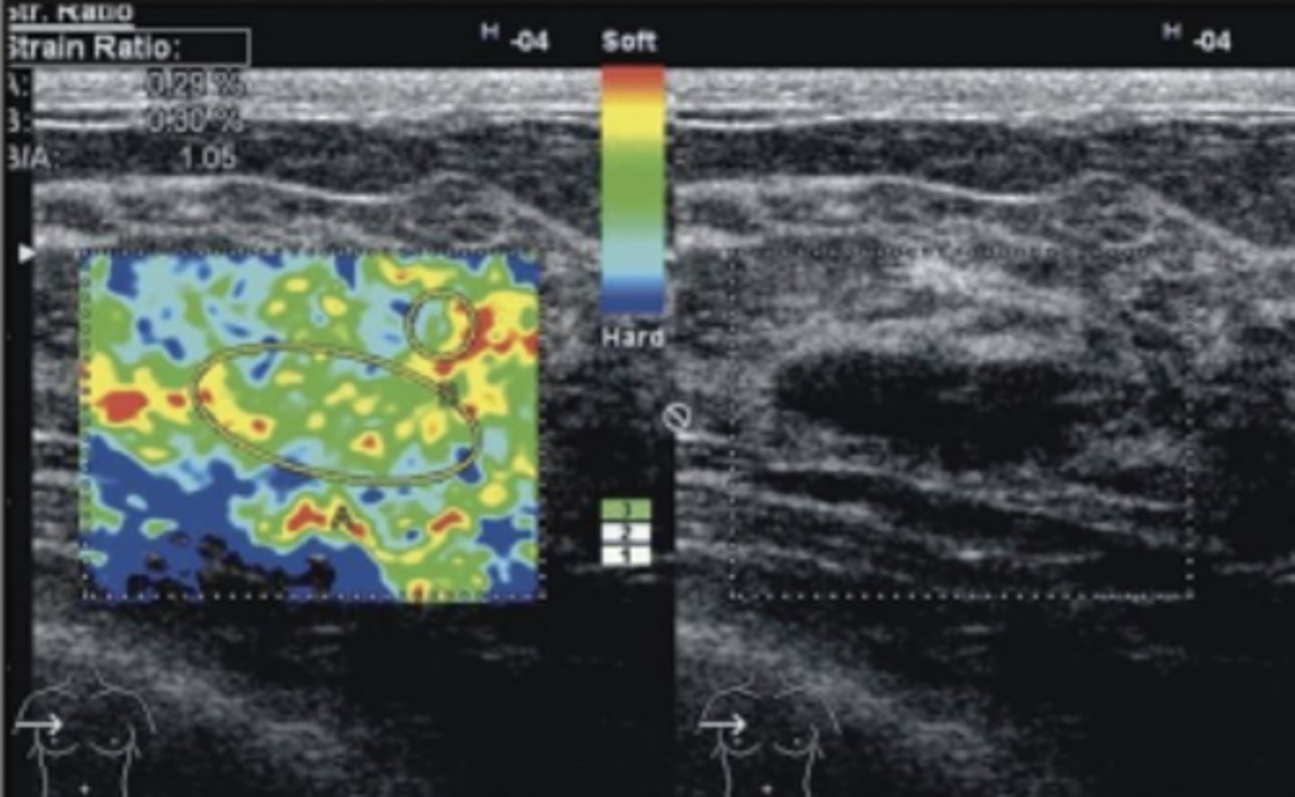 <p>Blue = Increased stiffness/hard</p><p>Red = Decreased stiffness/soft</p>