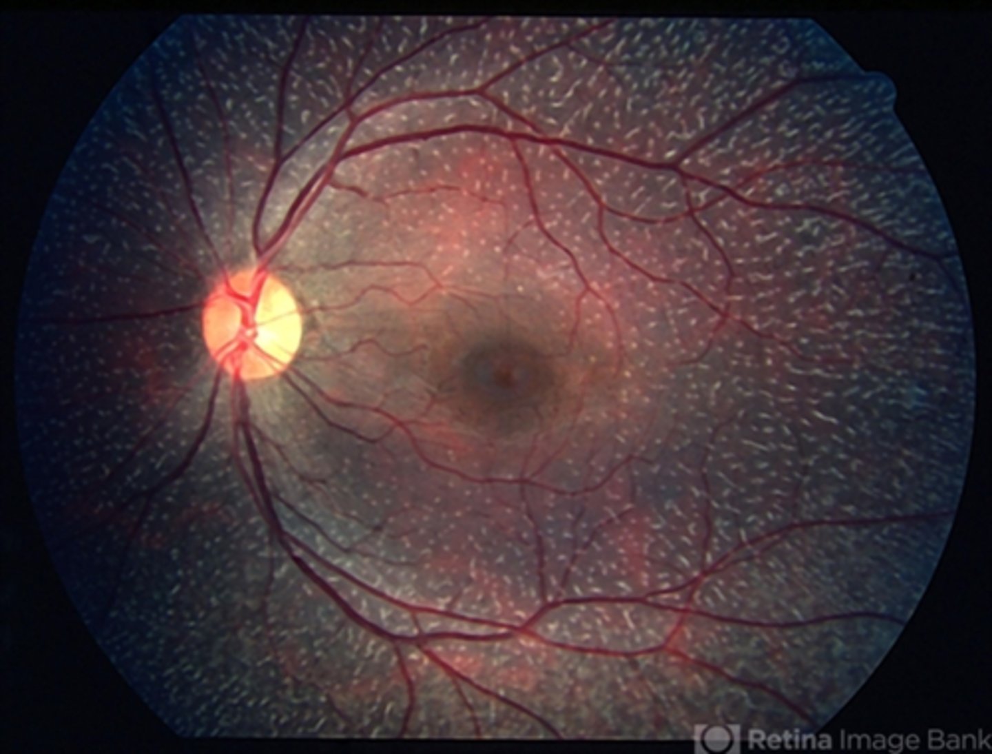 <p>scattered yellow-white dots in the posterior pole (sparing the macula) that extend to the mid-periphery = dots typically stable, may disappear over time</p>