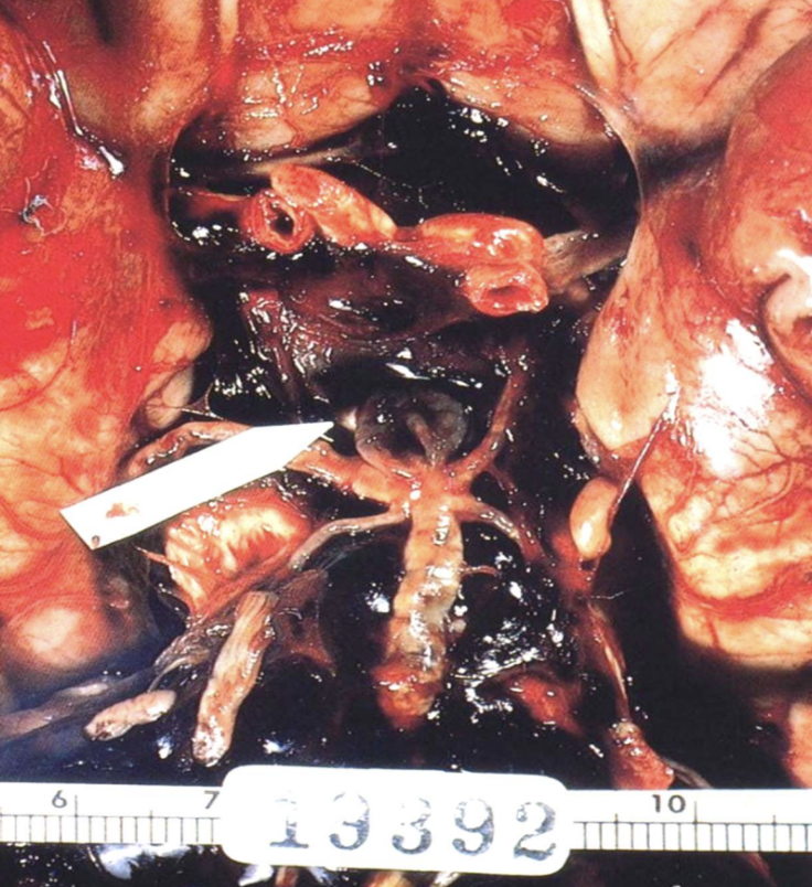 <p>Occurring during fetal development; present at birth (e.g., <strong>berry aneurysm</strong>). “born w/ it”</p>