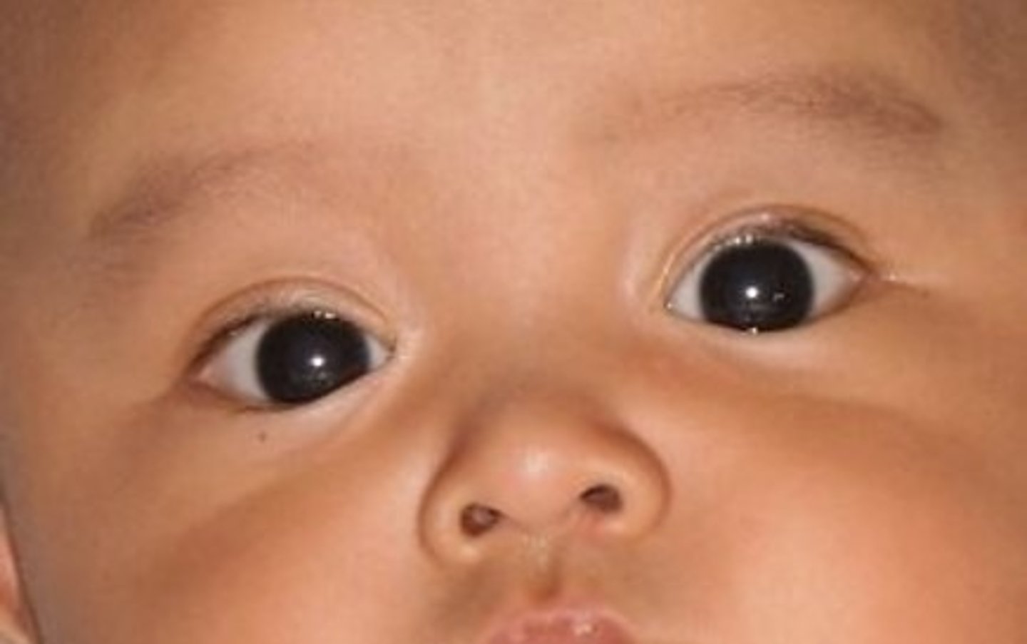 <p>pseudostrabismus</p>