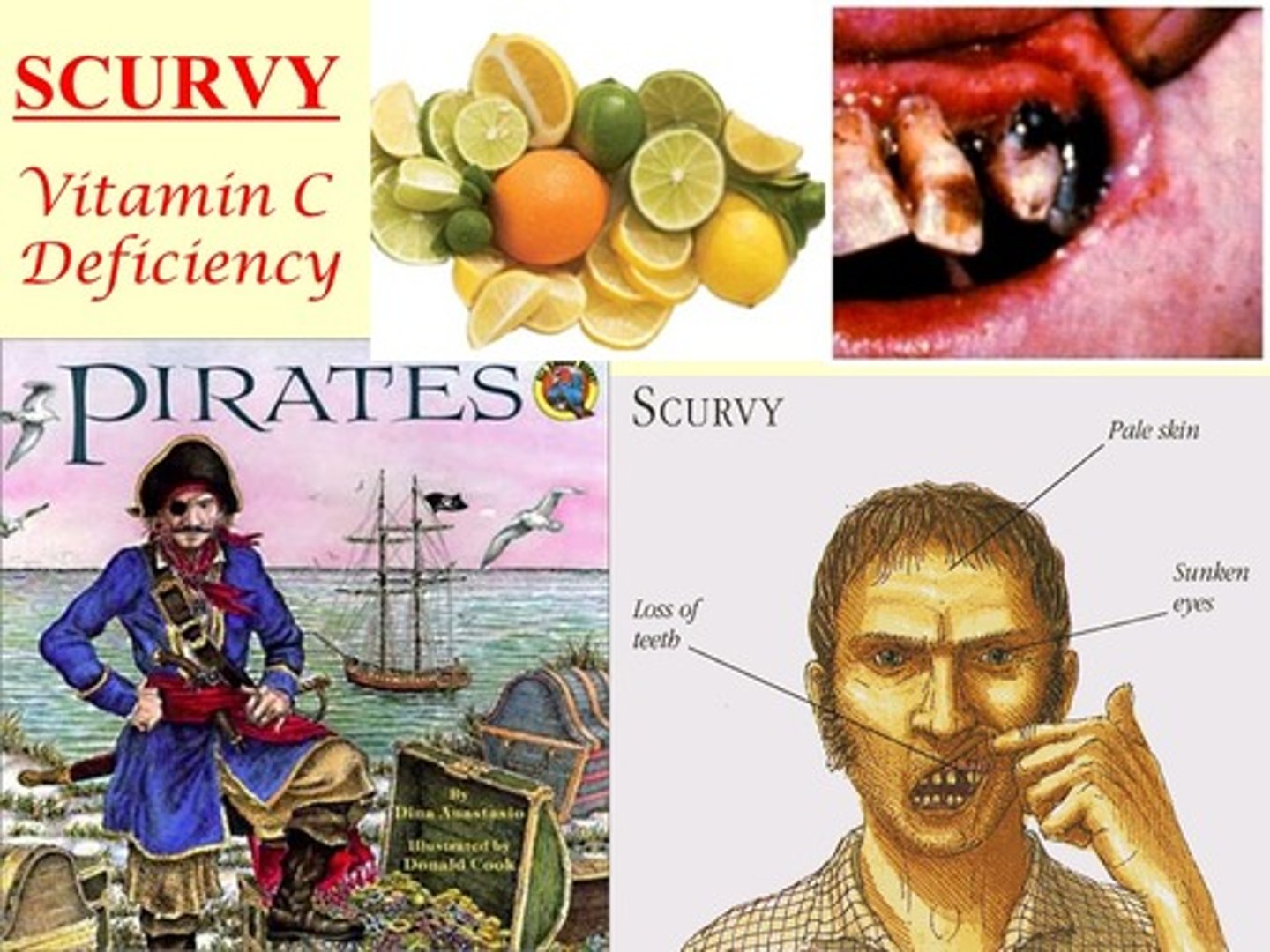 <p>scurvy</p>