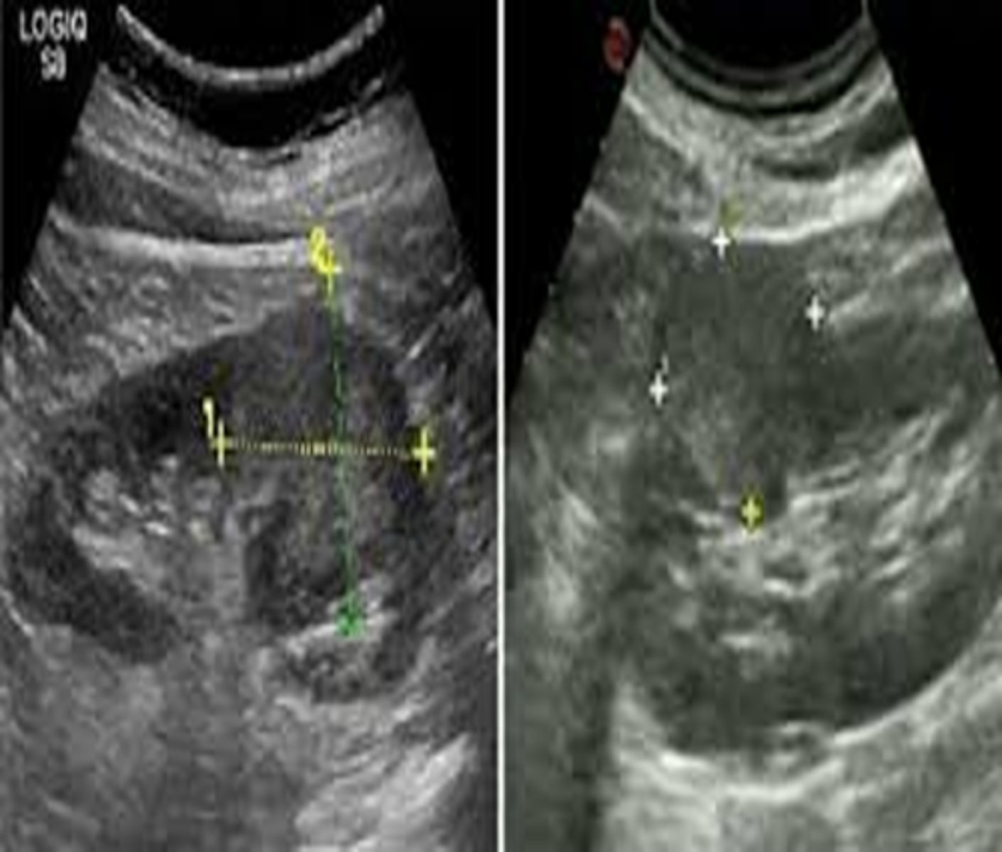 <p>Oncocytomas resemble a ___ ___ pattern with a central ___ </p>