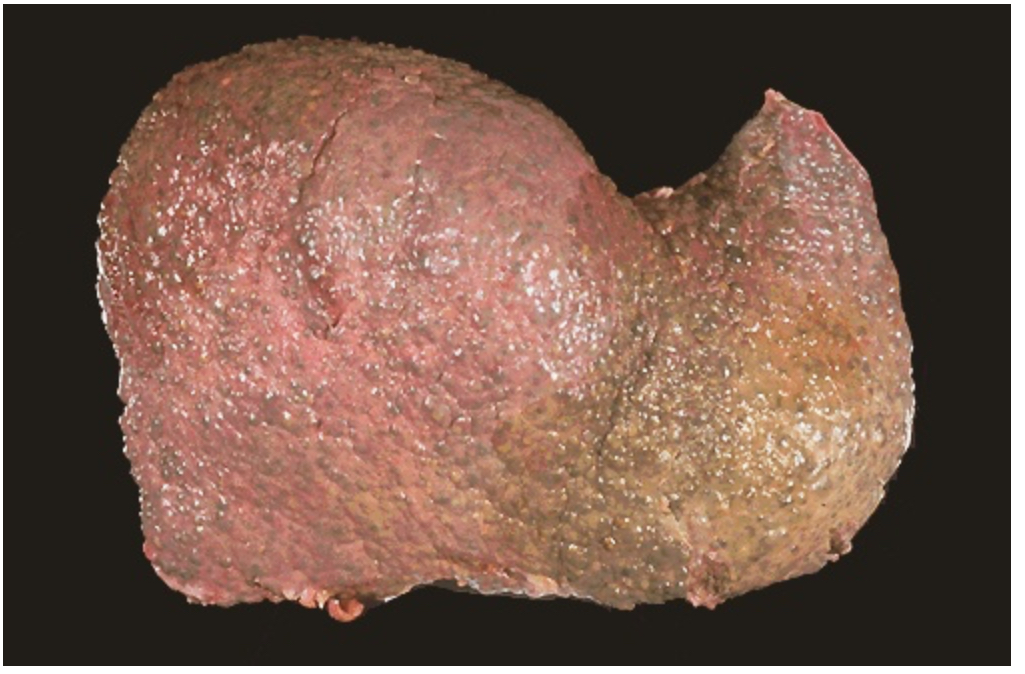 <p>Gross anatomy of a Liver with Injury caused by chronic alcoholism. This leads to ______ and regeneration of the hepatocytes in nodules. The firm, nodular appearance of the liver is called ______</p>