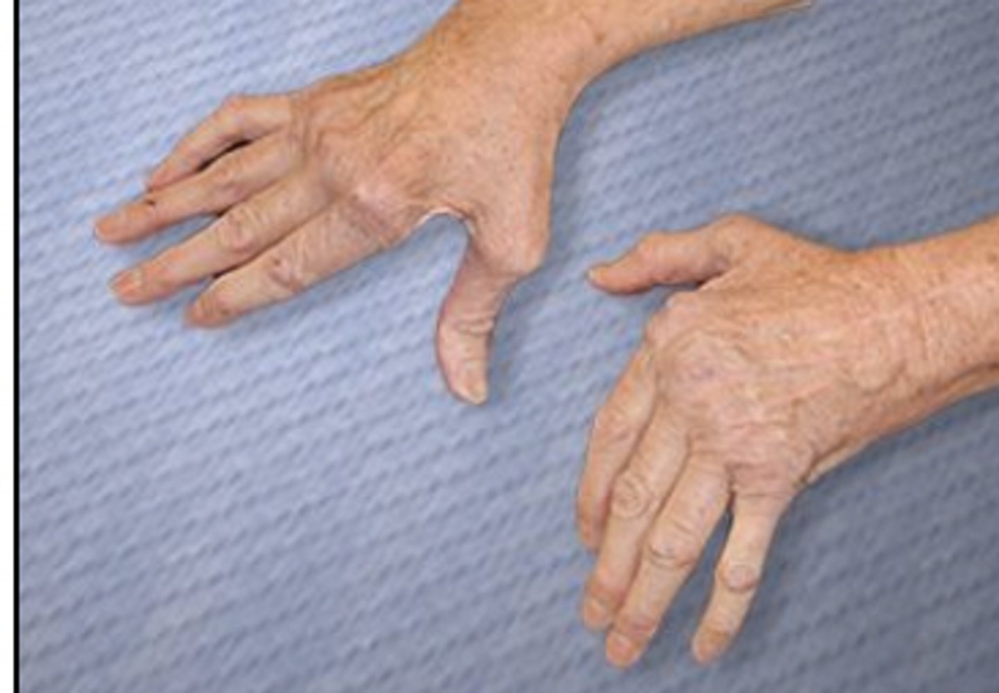 <p>Rationale</p><p>1. The patient in the photograph has rheumatoid arthritis (Goodman, p. 1323). Furosemide is a diuretic used for the treatment of hypertension, not the treatment of rheumatoid arthritis (Ciccone, p. 320).</p><p>2. The patient in the photograph has rheumatoid arthritis (Goodman, p. 1323). Metformin is indicated for diabetes, not rheumatoid arthritis (Ciccone, p. 519).</p><p>3. The patient in the photograph has rheumatoid arthritis. Methotrexate is a disease-modifying antirheumatic drug used in the treatment of rheumatoid arthritis. (Goodman, p. 1323; Ciccone, p. 240)</p><p>4. The patient in the photograph has rheumatoid arthritis (Goodman, p. 1323). Atenolol is a beta-adrenergic blocking agent used in the treatment of hypertension or angina, not rheumatoid arthritis (Ciccone, p. 311).</p>