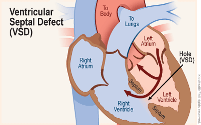 <p>hole in between the right and left ventricle.</p><ul><li><p>Oxygenated blood gets pushed from the left ventricle to the right ventricle.</p></li><li><p>loud murmur can be heard at left sternal border</p></li></ul>