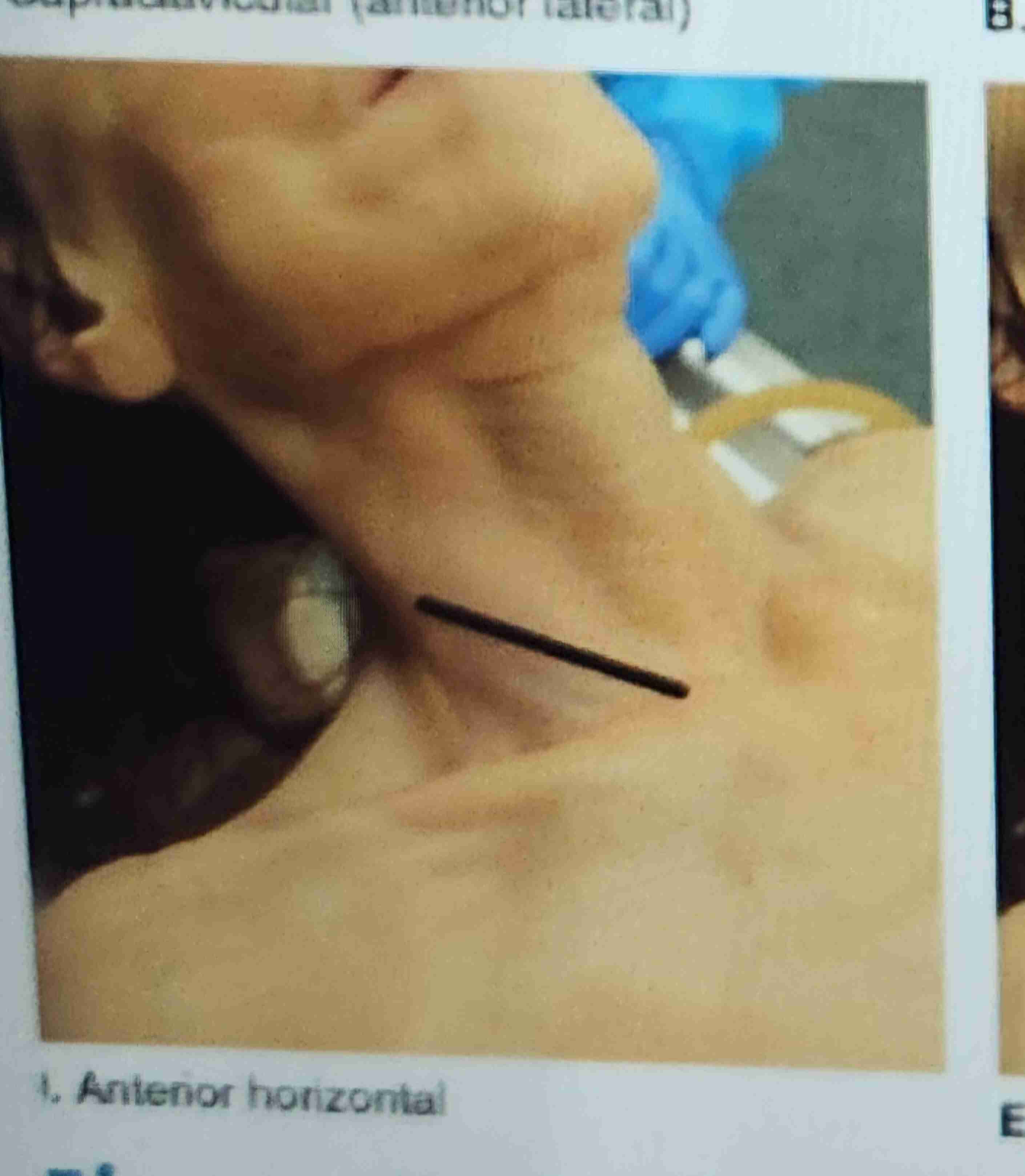 <p>Anterior Horizontal</p>