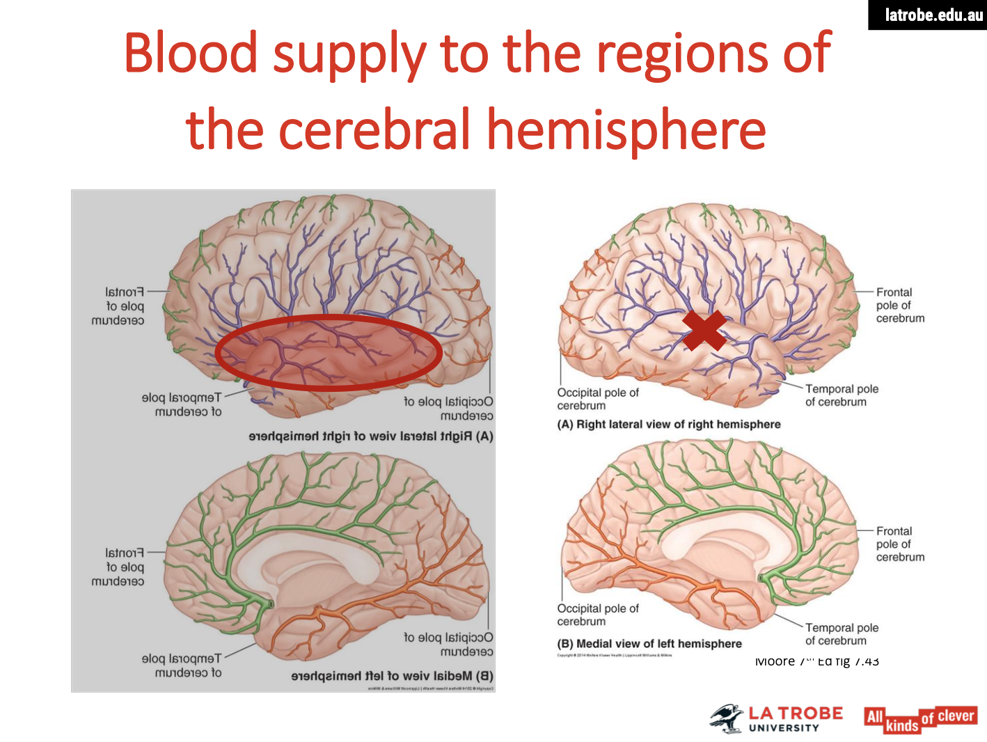 <p><span><strong>Affected Areas</strong></span></p><ul><li><p><span><strong>Left Temporal Lobe</strong>:</span></p><ul><li><p><span>Involves regions responsible for&nbsp;<strong>auditory processing</strong>&nbsp;and&nbsp;<strong>language comprehension</strong>.</span></p></li></ul></li><li><p><span><strong>Left Occipital Lobe</strong>:</span></p><ul><li><p><span>Primarily responsible for&nbsp;<strong>visual processing</strong>.</span></p></li></ul></li><li><p><span><strong>Inferior Part of the Parietal Lobe</strong>:</span></p><ul><li><p><span>Integrates sensory information from multiple modalities and is involved in&nbsp;<strong>spatial awareness</strong>.</span></p></li></ul></li></ul><p><span><strong>Possible Difficulties from Damage</strong></span></p><ol type="1"><li><p><span><strong>Language Comprehension Deficits:</strong></span></p><ul><li><p><span><strong>Damage in this area may lead to&nbsp;aphasia, specifically&nbsp;Wernicke’s aphasia, characterized by:</strong></span></p><ul><li><p><span><strong>Difficulty understanding spoken and written language.</strong></span></p></li><li><p><span><strong>Production of fluent but&nbsp;meaningless speech.</strong></span></p></li><li><p><span><strong>Individuals may produce long, rambling sentences that lack coherence.</strong></span></p></li></ul></li></ul></li><li><p><span><strong>Visual Processing Challenges:</strong></span></p><ul><li><p><span><strong>Damage reaching into the left occipital lobe may cause:</strong></span></p><ul><li><p><span><strong>Difficulties in&nbsp;visual recognition&nbsp;of objects, faces, or scenes (possibly leading to&nbsp;visual agnosia).</strong></span></p></li><li><p><span><strong>Impairment in interpreting visual information, affecting daily activities.</strong></span></p></li></ul></li></ul></li><li><p><span><strong>Spatial Awareness and Sensory Integration Issues:</strong></span></p><ul><li><p><span><strong>Involvement of the inferior part of the parietal lobe may result in:</strong></span></p><ul><li><p><span><strong>Impaired&nbsp;spatial awareness, affecting the ability to navigate the environment.</strong></span></p></li><li><p><span><strong>Challenges in&nbsp;integrating sensory information, leading to confusion about the location and movement of objects.</strong></span></p></li></ul></li></ul></li><li><p><span><strong>Overall Cognitive Difficulties:</strong></span></p><ul><li><p><span><strong>Individuals may experience:</strong></span></p><ul><li><p><span><strong>Challenges in&nbsp;comprehending complex instructions&nbsp;or narratives.</strong></span></p></li><li><p><span><strong>Difficulty in&nbsp;connecting sensory experiences&nbsp;(e.g., associating sounds with corresponding visual cues).</strong></span></p><img src="https://knowt-user-attachments.s3.amazonaws.com/bf1eabe7-5d3d-4b15-9153-7d7f68f3a313.png" data-width="100%" data-align="center"></li></ul></li></ul></li></ol><p></p>