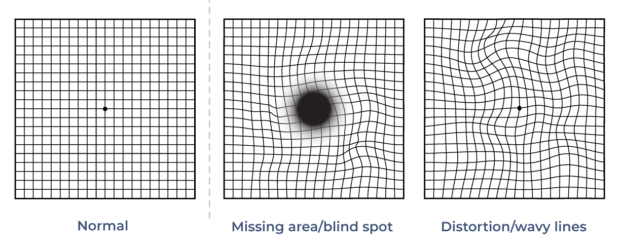 <p>Amsler grids </p>