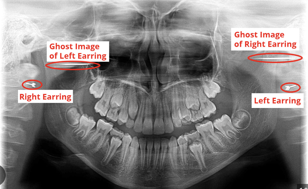 <p>This is when a real object on one side of the body is projected on the opposite side as more magnified, blurry, and higher up. It will have the same general shape as the object and will not be a mirror image.</p>