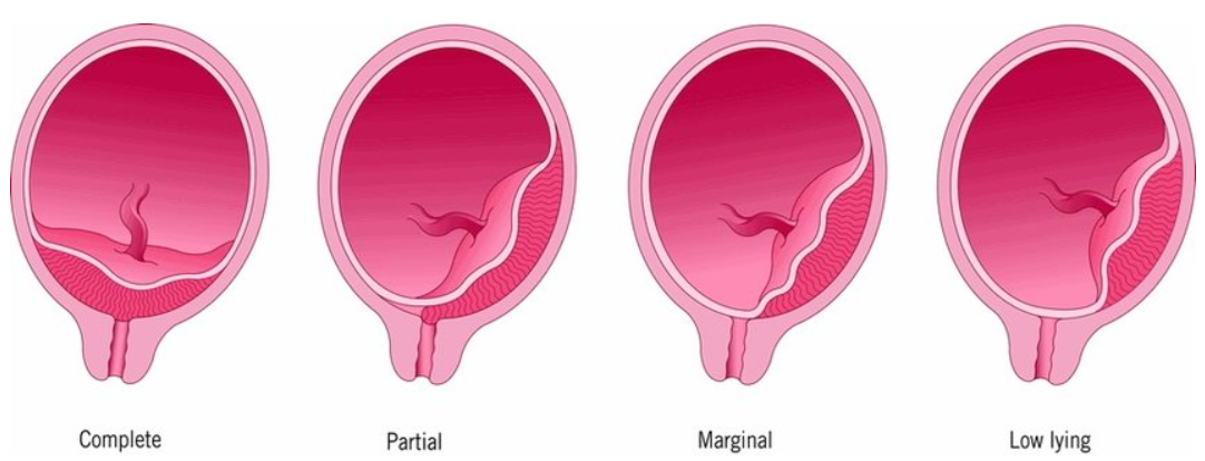 <ul><li><p><strong>Total/Complete:</strong> Internal os is <strong>completely</strong> covered by the placenta.</p></li><li><p><strong>Partial:</strong> Internal os is <strong>partially</strong> covered by the placenta.</p></li><li><p><strong>Marginal:</strong> Edge of the placenta is at the margin of the <strong>internal</strong> os.</p></li><li><p><strong>Low-lying placenta:</strong> Placenta is implanted in the lower segment but does not reach the os.</p></li></ul><p></p>