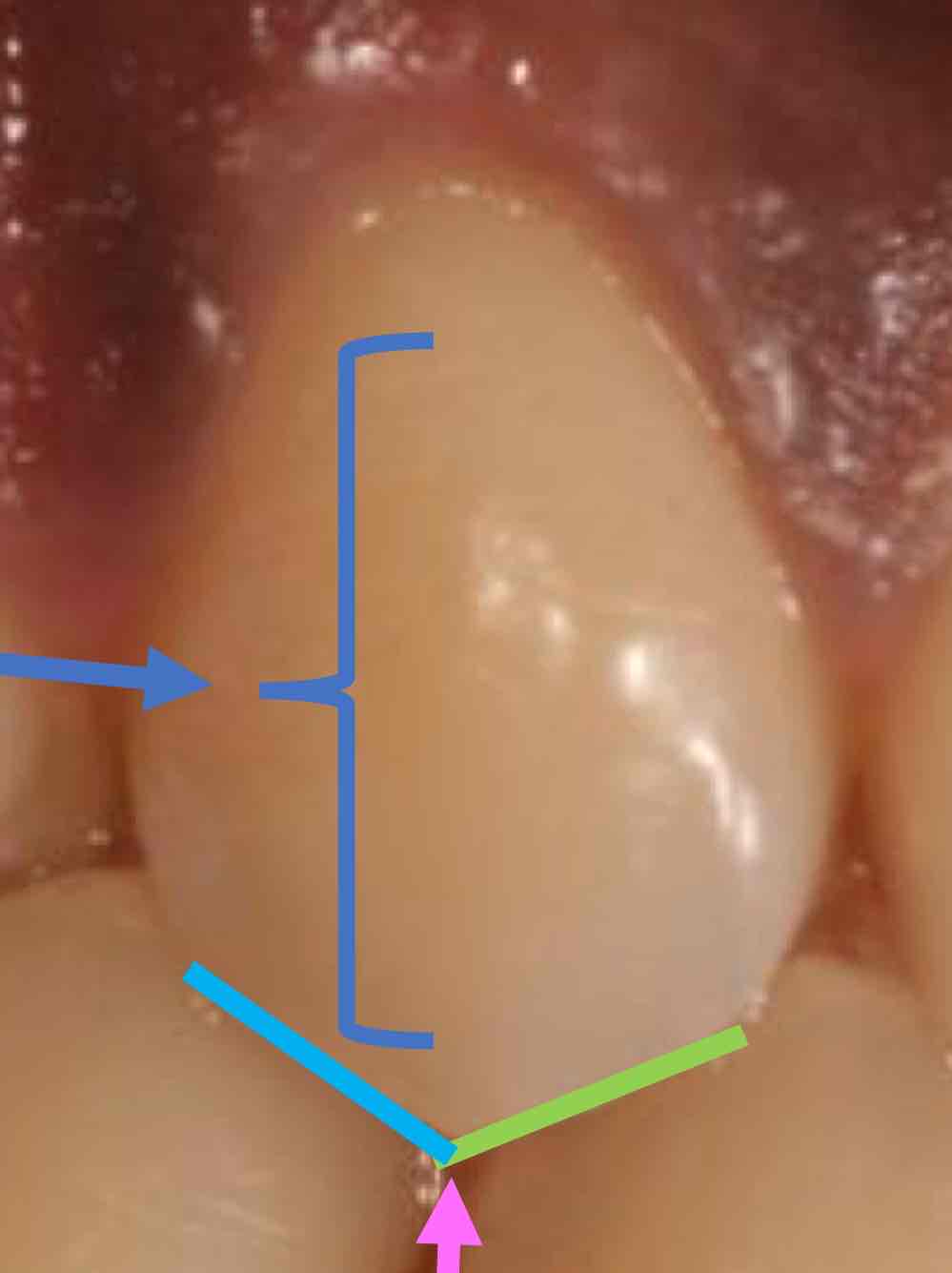 <p>determine the structure highlighted in dark blue </p><ul><li><p>hint: this structure is more pronounced on the maxillary canines</p></li></ul>