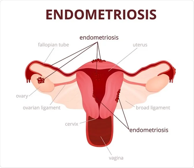 <p>Endometriosis</p>