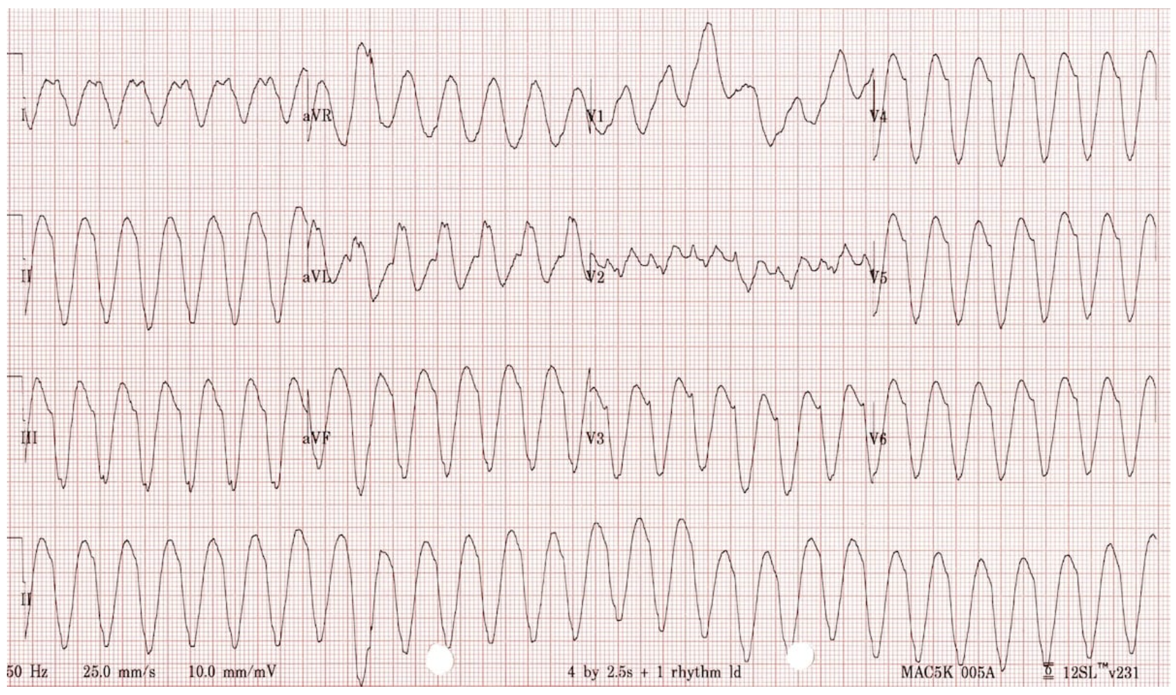 <p>Long term treatments for V tach peeps?</p>