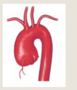 <p>An autoimmune disease occurs when the body's</p><p>immune system mistakenly attacks its own</p><p>healthy cells, tissues, and organs</p><p>It can cause inflammation of the aorta which may</p><p>cause complications like aneurysms and</p><p>dissections</p>