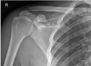 <p>What abnormality can be seen on this imaging?</p>