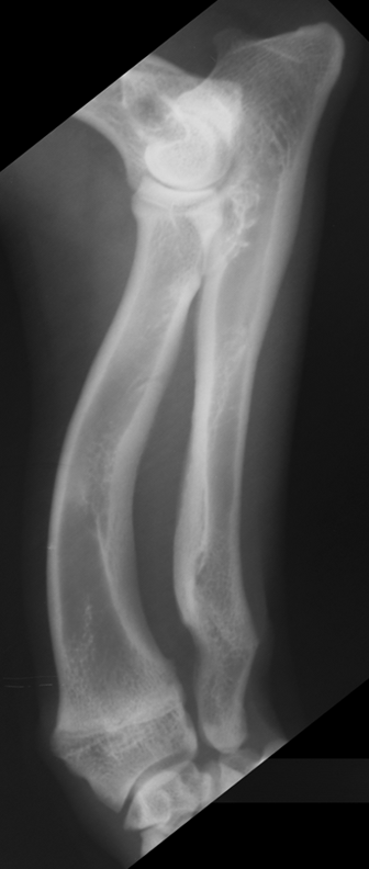 <p>which physis closed early</p>