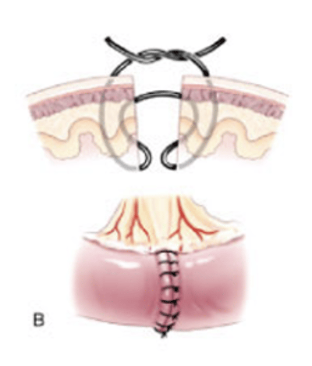<p>- Bite on each side passes into serosa, through muscularis and submucosa, mucosa, into lumen, then passes back through mucosa, submucosa and muscularis on the same side</p>