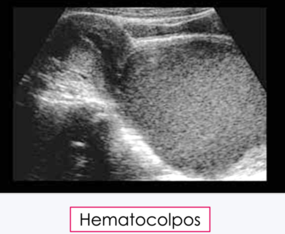 <p>What may result with an imperforate hymen?</p>