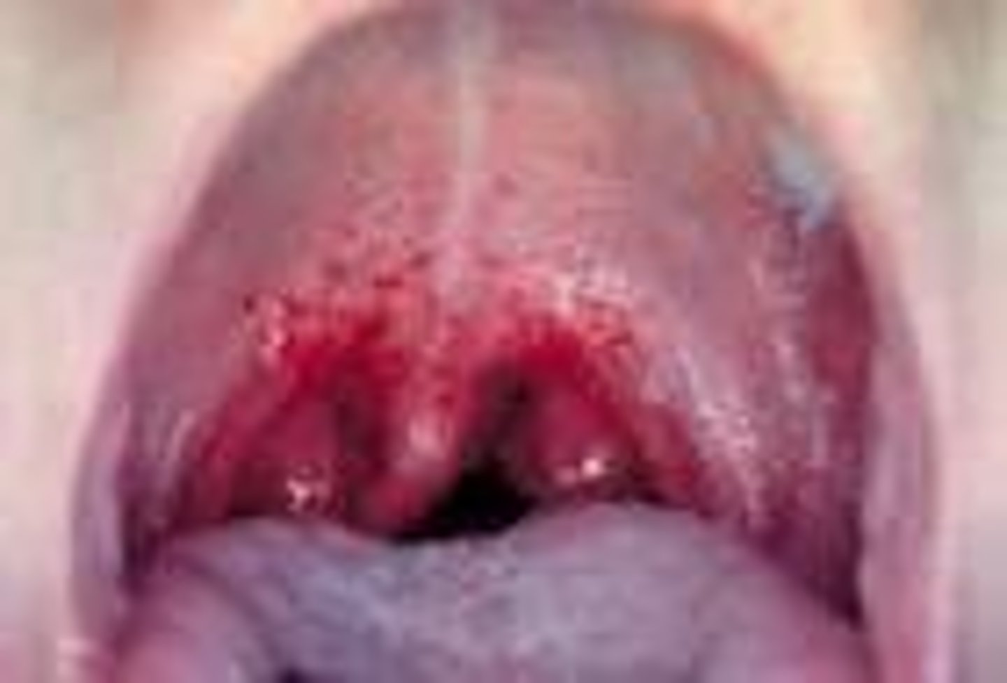 <p>- streptococcal pharyngitis</p><p>- pharyngitis (sore throat) are usually caused by cold viruses</p><p>- 30% of sore throat cases are caused by streptococcal pharyngitis </p><p>- 15-20% carriers in pharynx (endogenous)</p><p>- SYMPTOMS: inflamed pharynx & tonsils, fever, nausea, white pus nodules, headache</p><p>- COMPLICATIONS: scarlet fever, rheumatic fever, toxic shock, etc.</p><p>- TREATMENT: beta-lactam antibiotic</p>