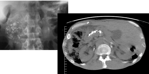 <p>Chronic pancreatitis -  diffuse calcifications</p>