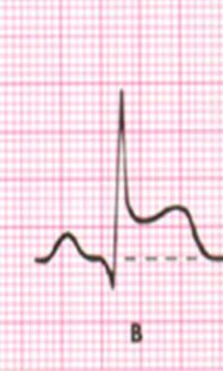 <p>what does an elevated ST segment indicate?</p>