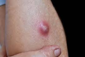 <p><span>A closed pocket containing pus. Some abscesses are easily diagnosed clinically, as they are painful and may "come to a head" such that pus becomes visible, but deep and chronic abscesses may just look like a TUMOR clinically and require biopsy to distinguish them from neoplasm.</span></p>