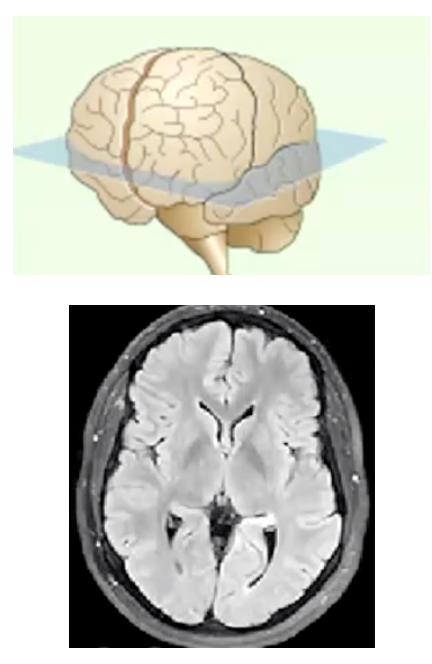 <p>Name the view/slice of the brain...</p>