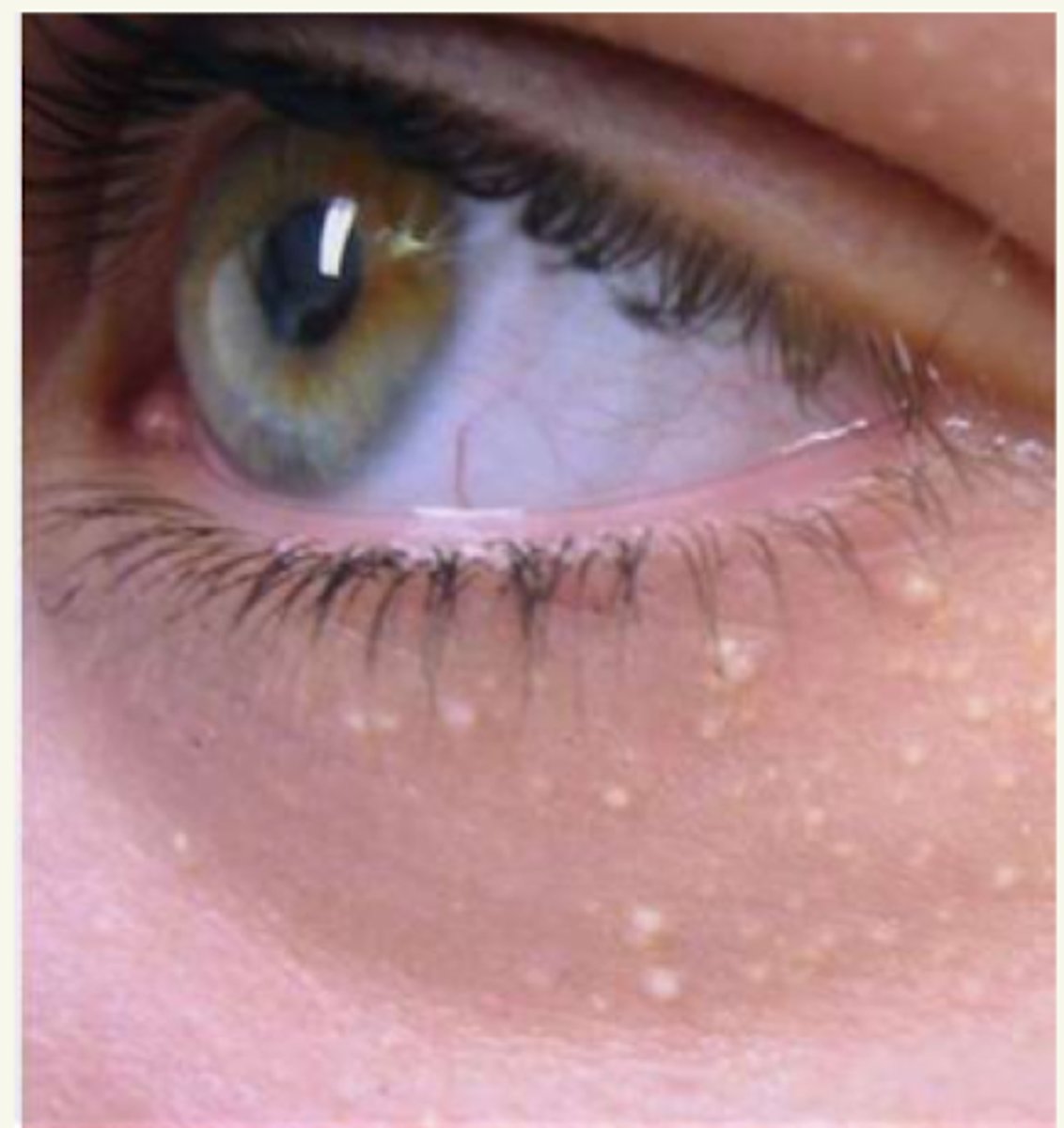 <p>¿lesión?</p><p>¿primaria o secundaria?</p>