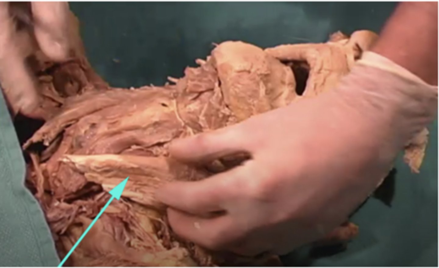 <p>What is the name of this muscle as indicated by the arrow?</p><p>-pectoralis major</p><p>-Cranial nerve IX (9)</p><p>-subcutaneous fascia</p><p>-sternocleidomastoid</p>