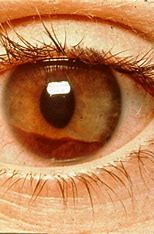 <p>= blood in the anterior chamber</p><ul><li><p>result of herpes zoster, trauma, or spontaneous hemorrhage</p></li></ul>