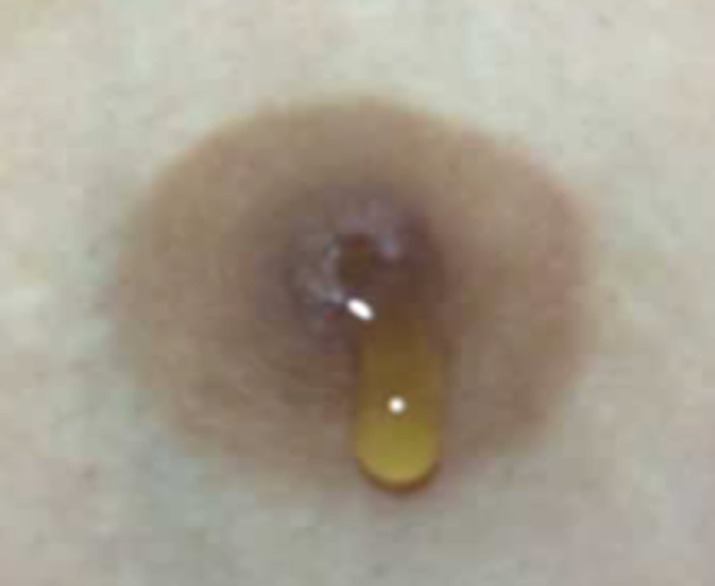 <p>Define Condition:</p><p>Mammary duct beneath the nipple becomes dilated and obstructed with fluid, often causing nipple discharge</p><p>-Hx: PERIMenopausal Women (45 - 55 y/o)</p><p>-Sx/PE:</p><p>&gt; Thick, GREEN Nipple discharge</p><p>&gt; Tenderness/Erythema of nipple and surrounding area</p><p>&gt; Can be Asx</p><p>-Tx: SELF-LIMITING (Tx w/ Abx if Bacterial Superinfection)</p>