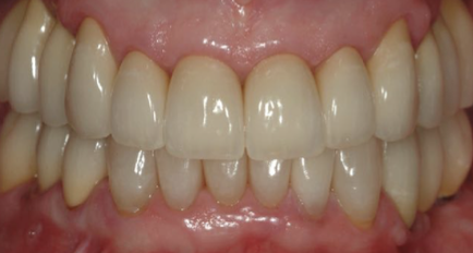 <p>All-Ceramic Restorations Advantages</p>