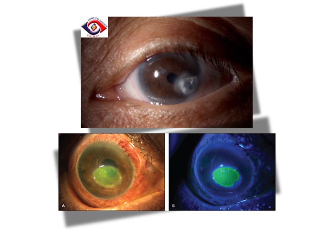 <p>fluorescein stain shows pooling, cornea is hazy</p>