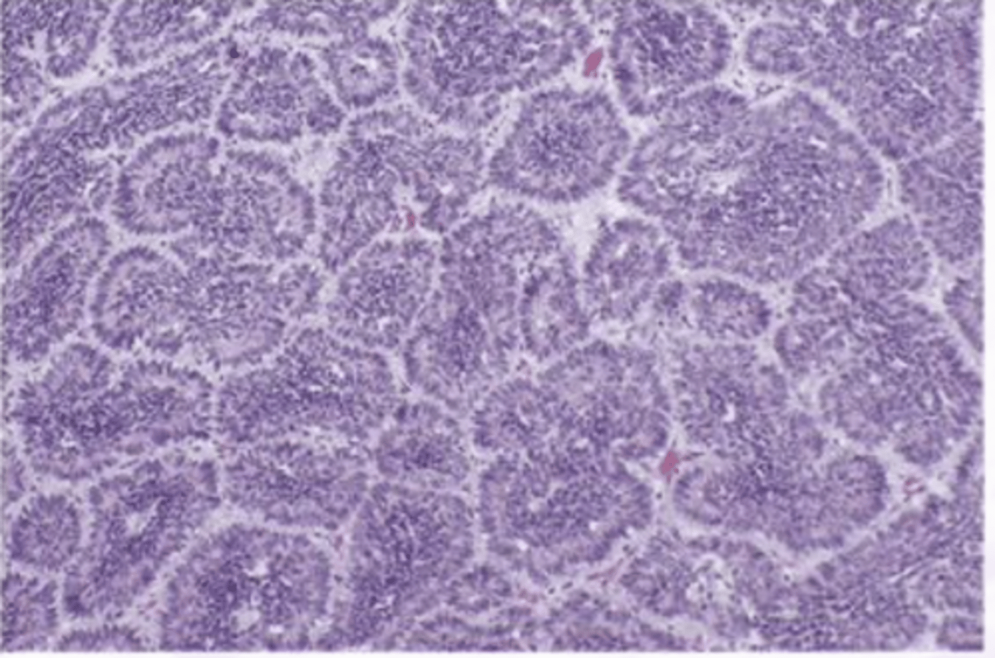 <p>Benign Salivary Gland Tumors:</p><p>Uncommon, Primarily tumor of Parotid</p>