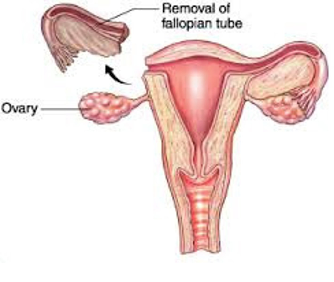 <p>excision of a fallopian tube</p>