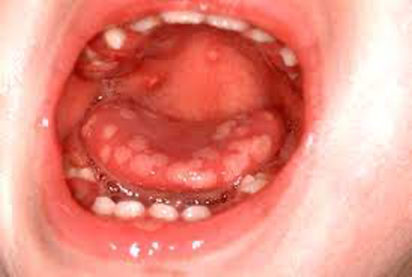 <p>initial HSV infection</p><p>• multiple oral vesicles rupture = ulcers</p><p>• Population: children</p>