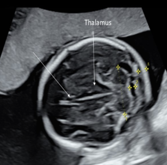 <p>what intracranial structure is located <strong>anterior</strong> to the lobes of the <strong>thalamus</strong></p><p>a) choroid plexus</p><p>b) 3rd ventricle</p><p>c) cavum septum pellucidum</p><p>d) cerebellum</p>