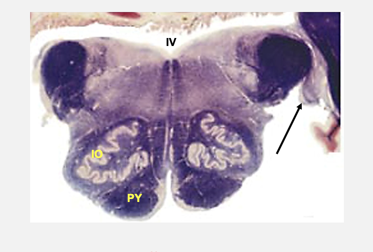 <p>pontomeduallary junction cross section cranial nerve nucelus&nbsp;</p><p></p><p></p>