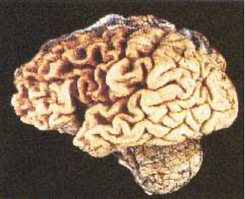 The change in the brain of this 82-year-old man is an example of