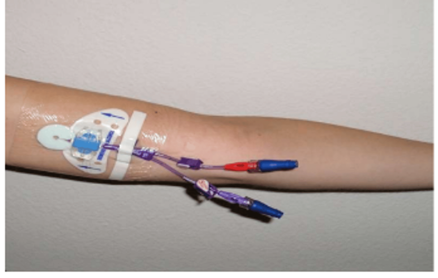 <p>Similar to central line, different origin insertion site.</p>