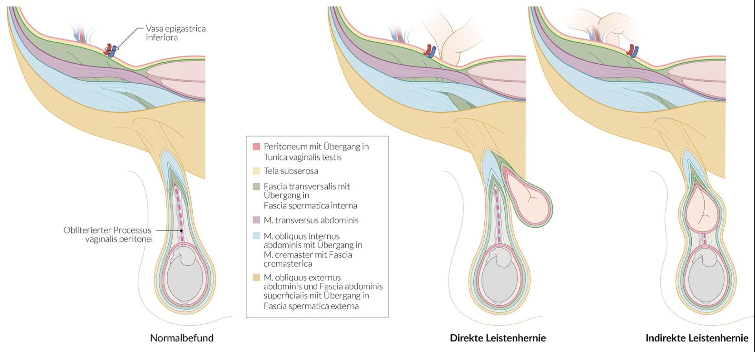 <p>B. Lateral inguinal fossa</p>
