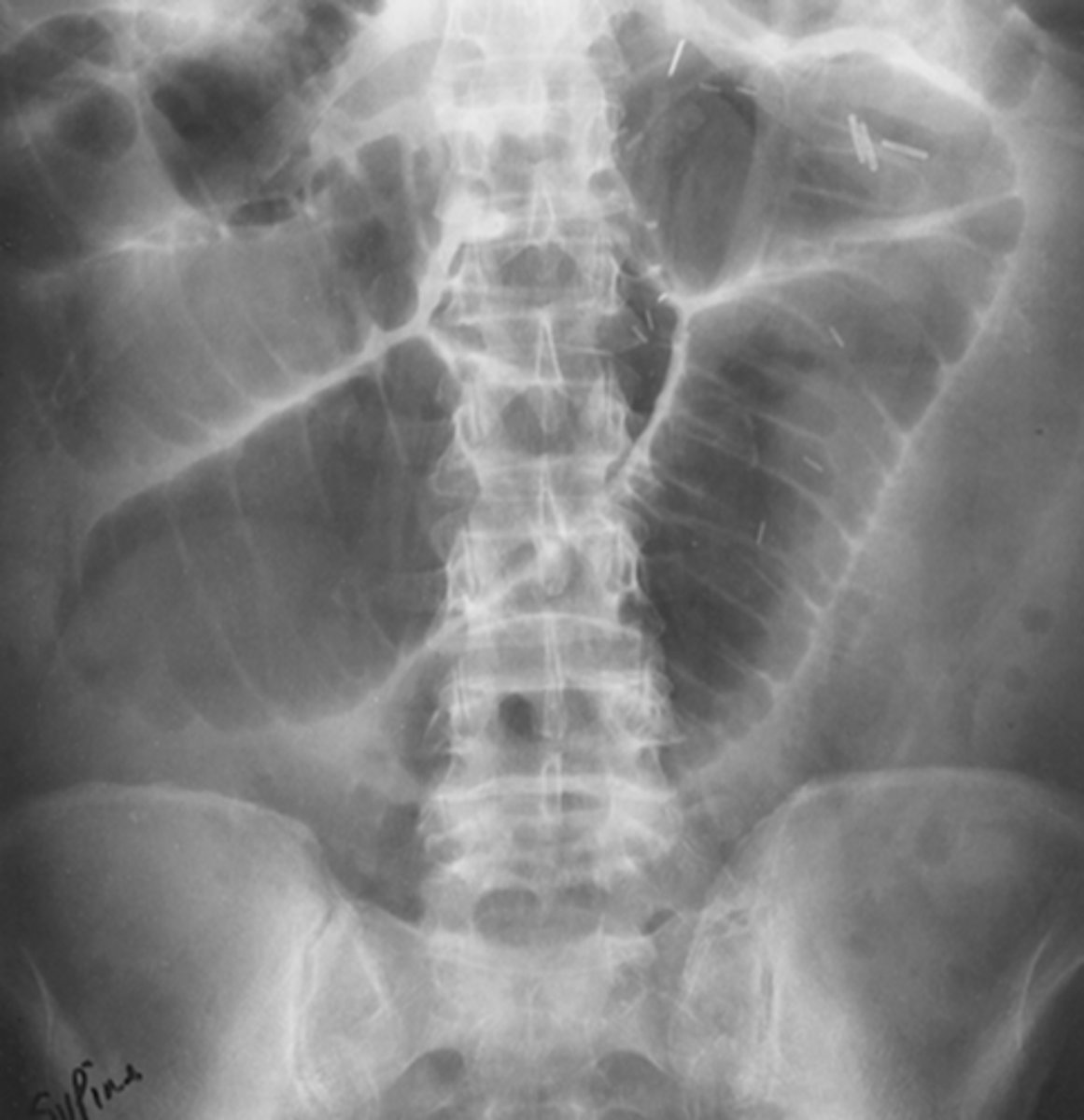 <p>thin, circumferential folds that extend across entire lumen of small bowel. Increased number in jejunum, appears like a stack of coins</p>