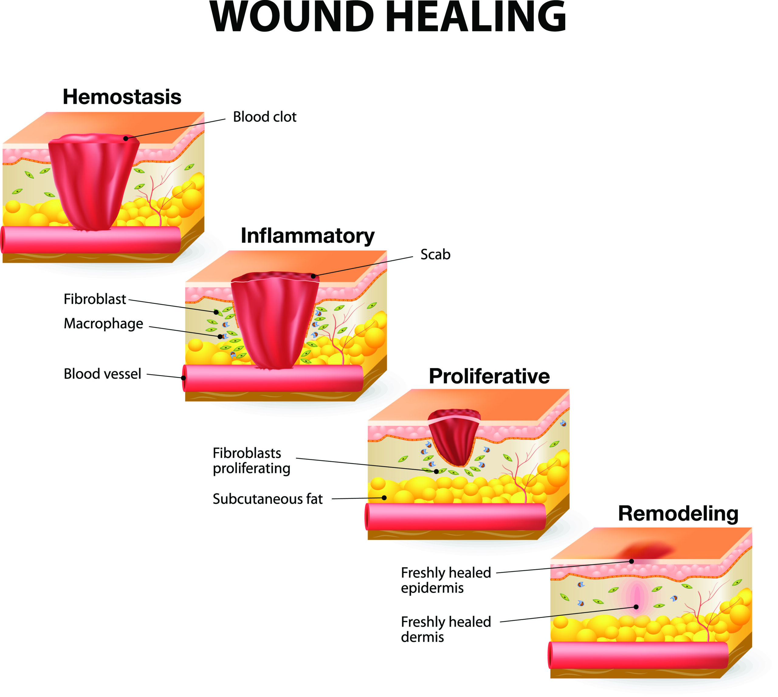 <p>Stages</p><p>1- Inflammatory Phase</p><ul><li><p><strong>Acute phase: 24/48 hours- 7 days</strong></p></li><li><p><strong>Subacute phase: 7- 14 days</strong></p></li><li><p>Typical Signs: redness, swelling, heat, pain</p></li><li><p>Signs of Infection that Require Attention:</p><ul><li><p>Pus, pain, purulent drainage, odor</p></li><li><p>Need antibiotics, proper debridement, cleaning, and dressing</p></li></ul></li><li><p>Systemic signs: fever, leukocytosis</p></li></ul><ul><li><p>Things occurring during this phase</p><ul><li><p>clotting</p></li><li><p>vasoconstriction</p></li><li><p>WBC migration</p></li><li><p>release of histamines/prostaglandins that cause vasodilation &amp; increased tissue permeability</p></li></ul></li></ul><p>2- Proliferative Phase</p><ul><li><p>aka fibroplastic/granulation/epitheliazation process</p></li><li><p>Things occurring during this phase:</p><ul><li><p>lactic/ascorbic acid stimulate fibroblasts to synthesize collagen</p></li><li><p>cross linkage of collagen increases the tensile strength of repaired skin to 80%</p></li><li><p>Epithelialization resurfaces the wound</p></li><li><p>Tissue granulation forms new collagen and blood vessels</p></li><li><p>Myofibroblasts connect to the wound margins</p></li><li><p>Wound contraction takes<strong> 5 days up to 3 weeks</strong></p><ul><li><p>Linear wounds heal quickly</p></li><li><p>Rectangular wounds heal moderately quickly</p></li><li><p>Circular wounds heal the most slowly</p></li></ul></li></ul></li></ul><p>3- Maturation/Remodeling Phase</p><ul><li><p>Lasts from <strong>2 weeks to 1-2 years</strong></p></li><li><p>Things occurring during this phase:</p><ul><li><p>Scar tissue first consists of randomly arranged collagen fibers, but as the scare matures, the collagen is broken down and remodeled</p><ul><li><p>The scar becomes more elastic, smoother, and stronger</p></li></ul></li></ul></li><li><p>If collagen synthesis exceeds collagen lysis, hypertrophic &amp; keloid scars can form</p></li><li><p>Pressure garments help collagen fibers realign in linear/lateral orientation</p></li><li><p>Dynamic splinting, serial casting, continuous passive motions, positional stretching, NMES, and silastic gel pads can help decrease hypertrophic scarring</p></li></ul><p></p><p>Types</p><p>Primary healing: the use of sutures, plates, screws</p><ul><li><p>Delayed Primary healing: wound is cleaned/debrided and observed ~5 days before suturing it closed</p></li></ul><p>Secondary healing: when the wound cannot easily be closed (jagged edges), it is left to heal more naturally <br>Tertiary healing: need for the wound to be left open (fluid secretions)</p><p></p>