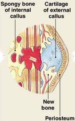 <p>Which step of fracture repair have:</p><ul><li><p><span style="color: yellow;"><strong>Bone growth stabilizes the break</strong></span>:</p><ul><li><p><span style="color: yellow;"><strong>External callus</strong></span> of the cartilage and bone surrounds break</p></li><li><p><span style="color: yellow;"><strong>Internal callus</strong></span> develops in marrow cavity</p></li></ul></li></ul><p></p>