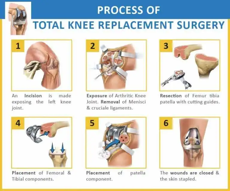 <p>total knee arthroplasty procedure</p>