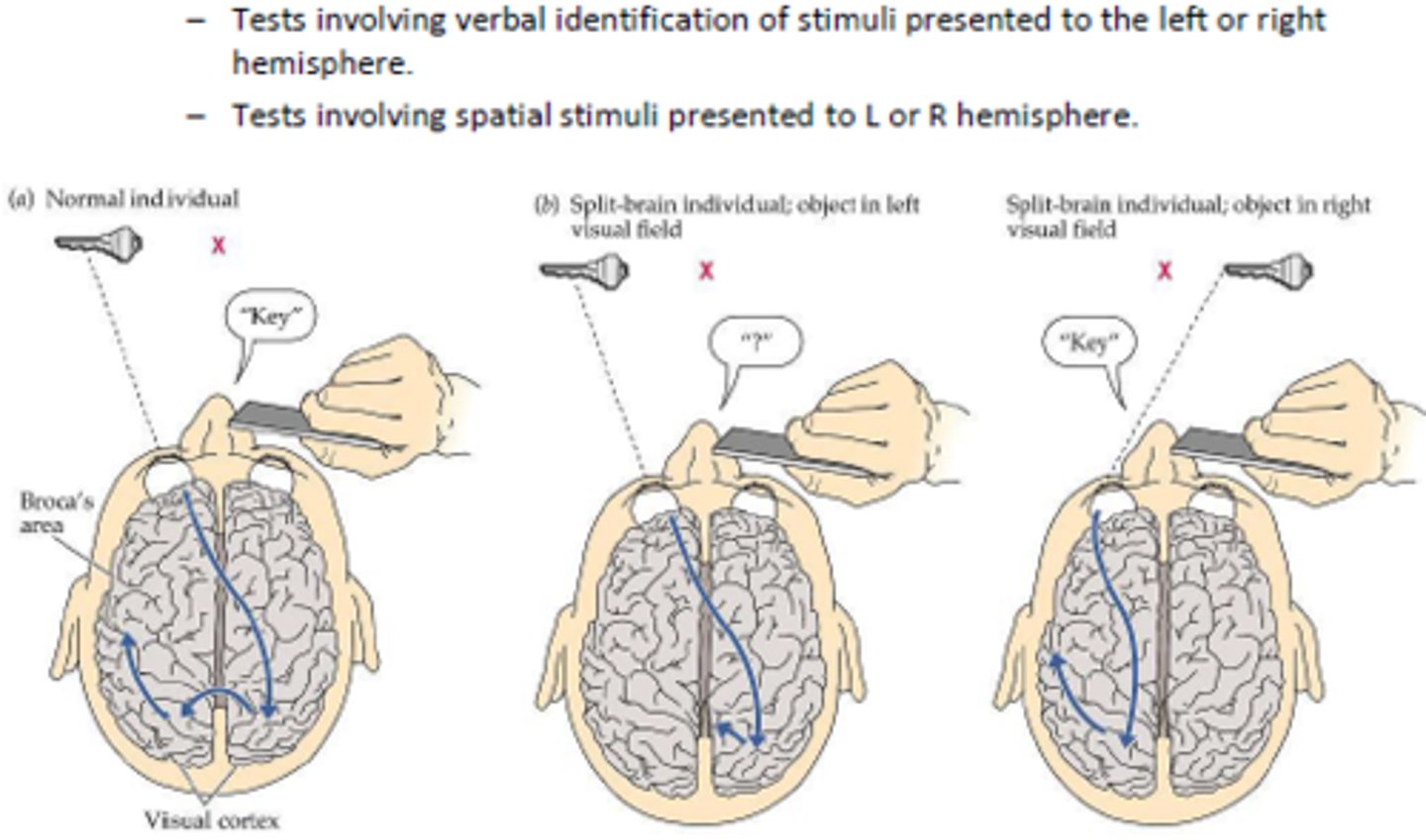 <p>Corpus callosum cut in patients with severe epilepsy, allowing researchers to investigate the extent to which brain function is lateralised.</p>