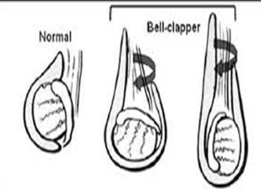 <p>What is a predisposing factor in testicular torsion in which the tunica vaginalis joins high on the spermatic cord, leaving the testis free to rotate, <strong>____ </strong>predisposes to intravaginal torsion of the testis?</p><p>•Without this attachment, testicle can rotate freely on spermatic cord (bell clapper deformity)</p>